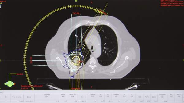 Imagen radiológica de la nueva técnica de radioterapia de Son Espases Imagen radiológica de la nueva técnica de radioterapia de Son Espases