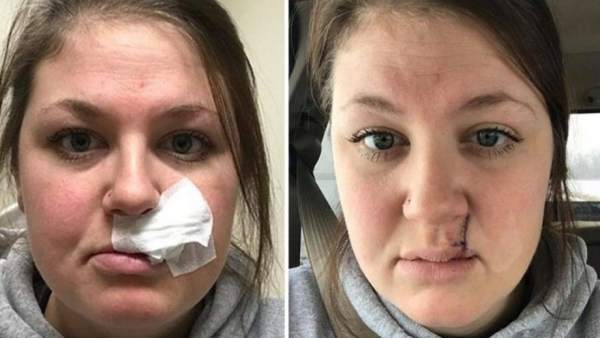 Una mujer comparte sus secuelas de cáncer de piel para concienciar sobre los rayos UVA Una mujer comparte sus secuelas de cáncer de piel para concienciar sobre los rayos UVA