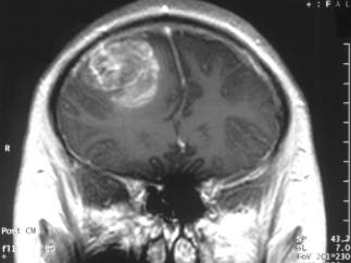 Glioblastoma
