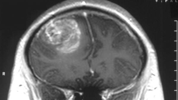Glioblastoma Glioblastoma
