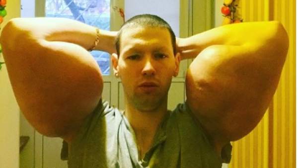 El 'popeye ruso' teme perder su vida por inyectarse un aceite para ganar volumen en sus brazos. El 'popeye ruso' teme perder su vida por inyectarse un aceite para ganar volumen en sus brazos.