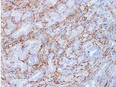 Aumenta la mortalidad por cáncer de páncreas, el "asesino silencioso"