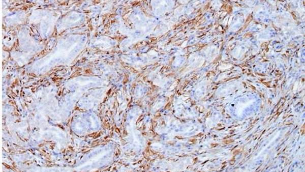 Células tumorales de cáncer de páncreas, mostrando en marrón la Galectina 1 Células tumorales de cáncer de páncreas, mostrando en marrón la Galectina 1