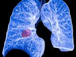 Un tratamiento contra el cáncer de pulmón reduce en un 51% el riesgo de muerte