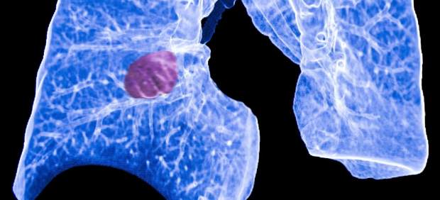 Cáncer de pulmón