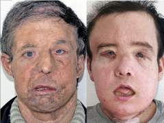 Jérôme Hamon, la primera persona que supera dos trasplantes de rostro