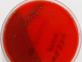 Meningitis