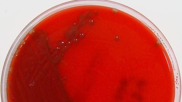 Meningitis Meningitis