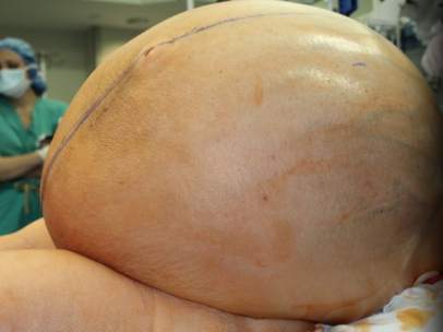 Tumor