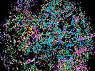 Imagen de un tumor.