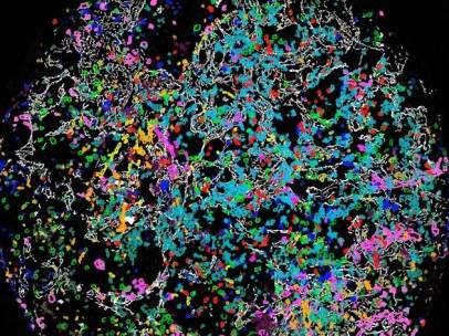 Imagen de un tumor.