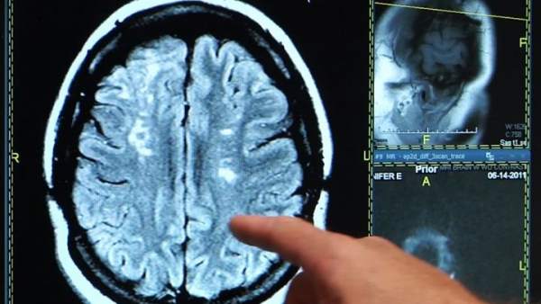Ictus, derrame cerebral, cerebro Ictus, derrame cerebral, cerebro