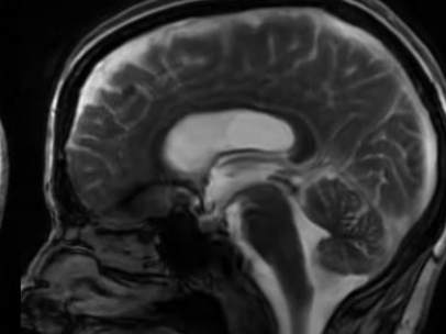 Cerebro