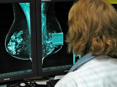 Investigación sobre el cáncer de mama
