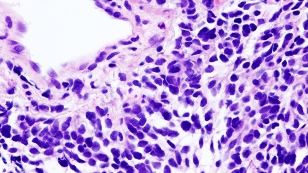 Carcinoma de pulmón de células pequeñas Carcinoma de pulmón de células pequeñas