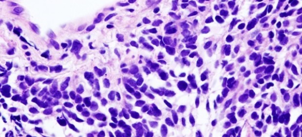 Carcinoma de pulmón de células pequeñas