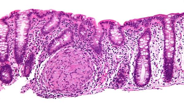 Biopsia endoscópica donde se puede apreciar inflamación granulomatosa del colon Biopsia endoscópica donde se puede apreciar inflamación granulomatosa del colon