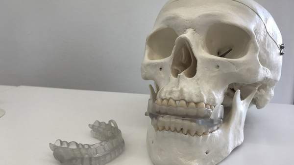 Dispositivo bucal para prevenir la apnea del sueño diseñado en la UMA Dispositivo bucal para prevenir la apnea del sueño diseñado en la UMA
