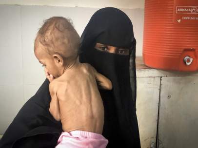 Niño con desnutrición en Yemen