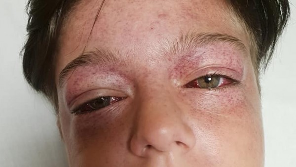 Tyler tiene los ojos abultados e inyectados en sangre. Tyler tiene los ojos abultados e inyectados en sangre.