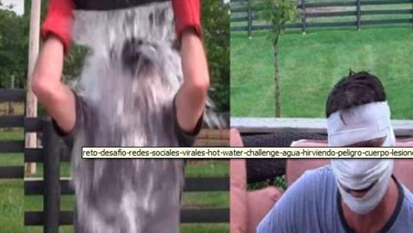 Las consecuencias del ret 'hot water' challenge Las consecuencias del ret 'hot water' challenge