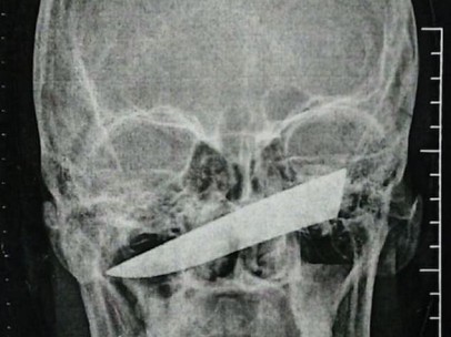 Imágenes del cuchillo clavado en la cara del hombre.