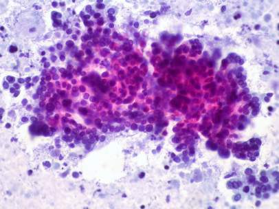 Cáncer de páncreas