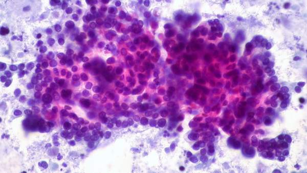 Cáncer de páncreas Cáncer de páncreas