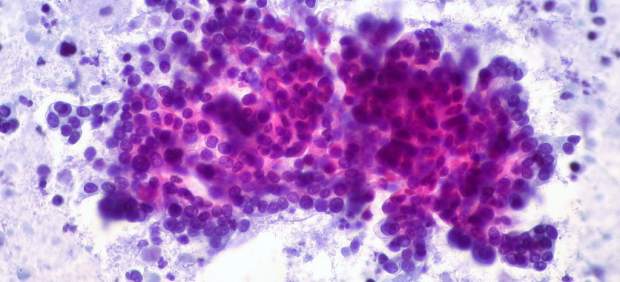 Cáncer de páncreas