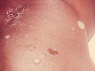 Impetigo