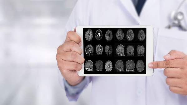 Alzheimer Alzheimer