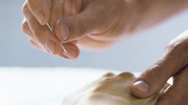 Acupuntura Acupuntura