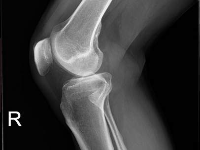 Rodilla