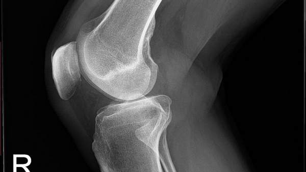 Rodilla Rodilla