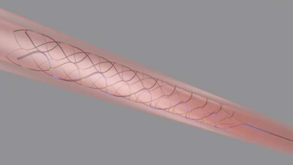 Stentrode Stentrode
