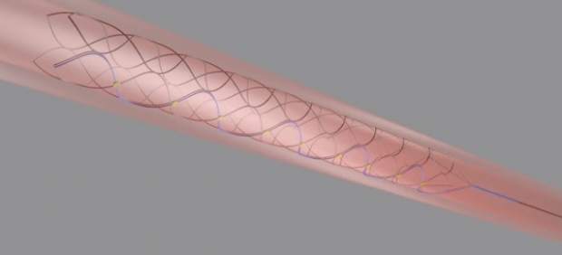 Stentrode