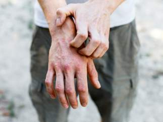 Dermatitis