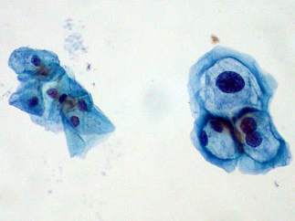 Virus del Papiloma Humano (VPH).