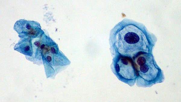Virus del Papiloma Humano (VPH). Virus del Papiloma Humano (VPH).