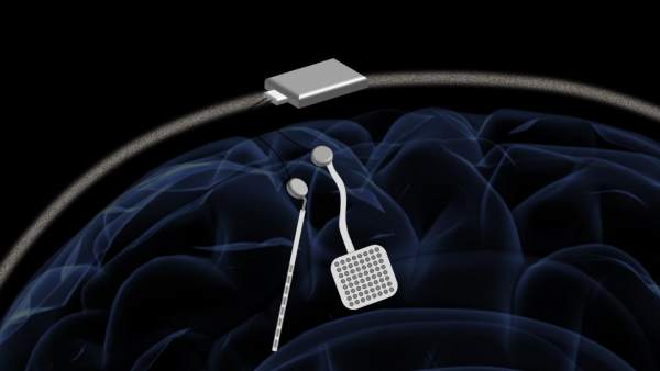 Marcapasos inalámbrico para el cerebro Marcapasos inalámbrico para el cerebro