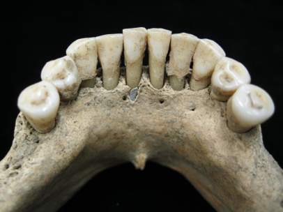 Lapislázuli en los dientes