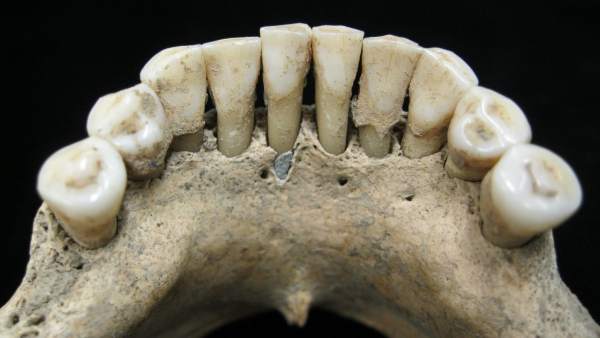 Lapislázuli en los dientes Lapislázuli en los dientes
