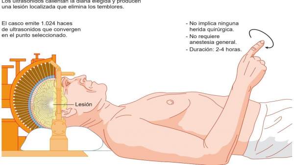 Tecnología HIFU para tratar sin cirugía el temblor de Parkinson Tecnología HIFU para tratar sin cirugía el temblor de Parkinson