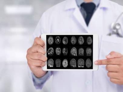 Alzheimer