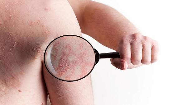 Psoriasis, enfermedad inflamatoria Psoriasis, enfermedad inflamatoria