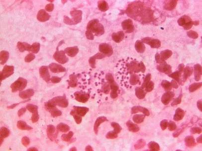 Neisseria gonorrhoeae, gonorrea
