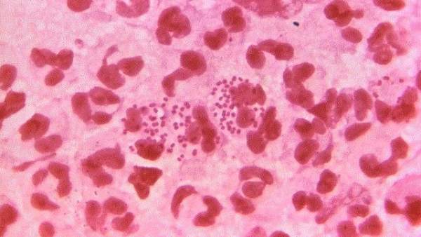 Neisseria gonorrhoeae, gonorrea Neisseria gonorrhoeae, gonorrea