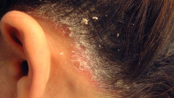 L'Arnau de Vilanova obri la primera consulta multidisciplinària de dermatologia i endocrinologia per a tractar psoriasi L'Arnau de Vilanova obri la primera consulta multidisciplinària de dermatologia i endocrinologia per a tractar psoriasi