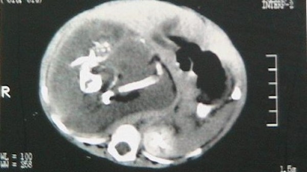 'Fetus in fetu' 'Fetus in fetu'