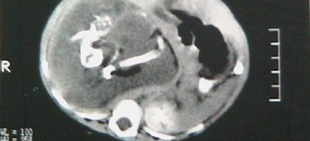 'Fetus in fetu'